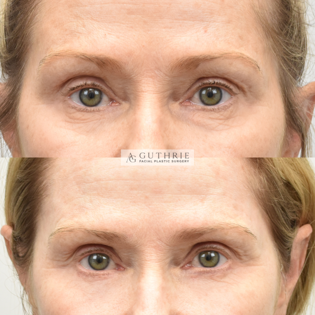 patient at guthrie facial plastic surgery before and after lower blepharoplasty with fat transfer - brentwood tn