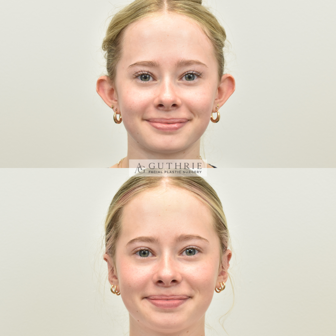 patient before and after otoplasty in brentwood tn - guthrie facial plastic surgery