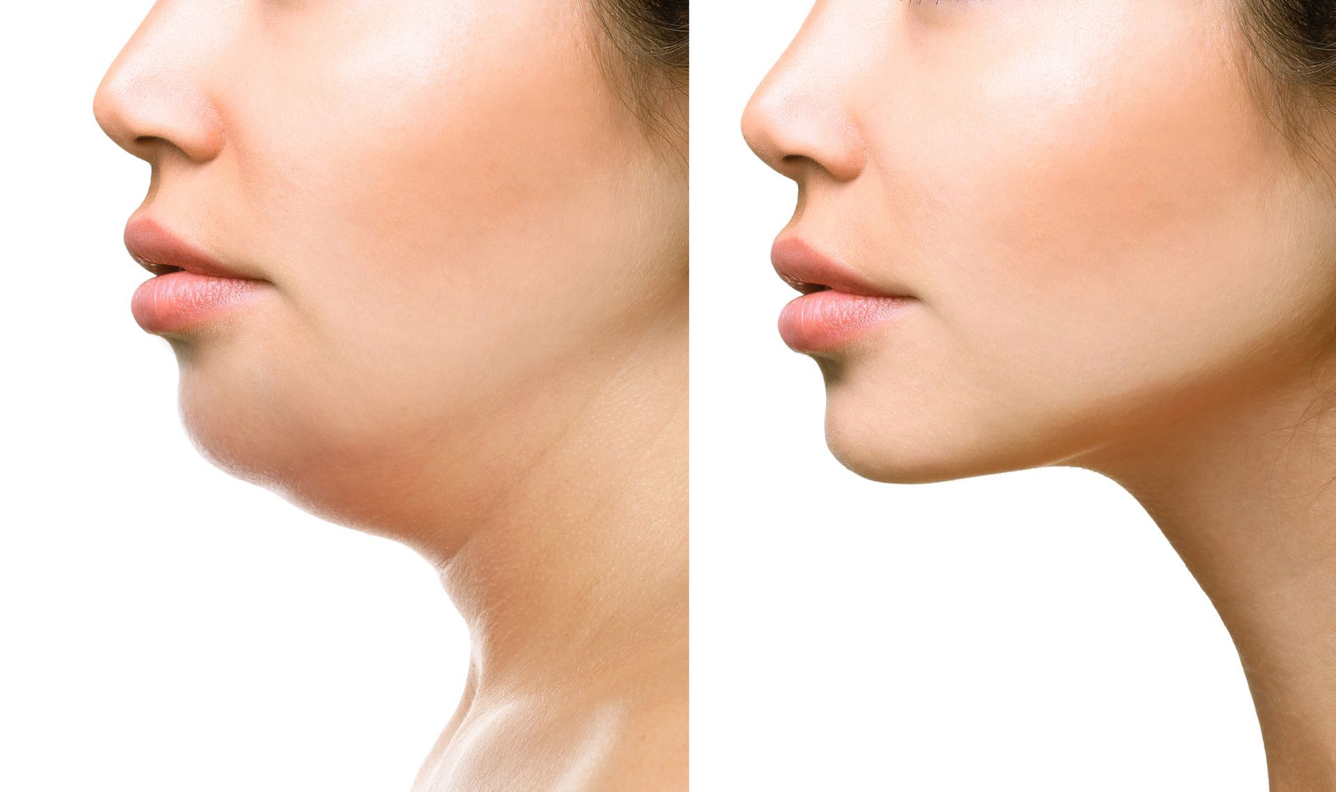 Side-by-side profile close-ups of a woman's chin and jawline, showing a smoother left side and a sharper right side.