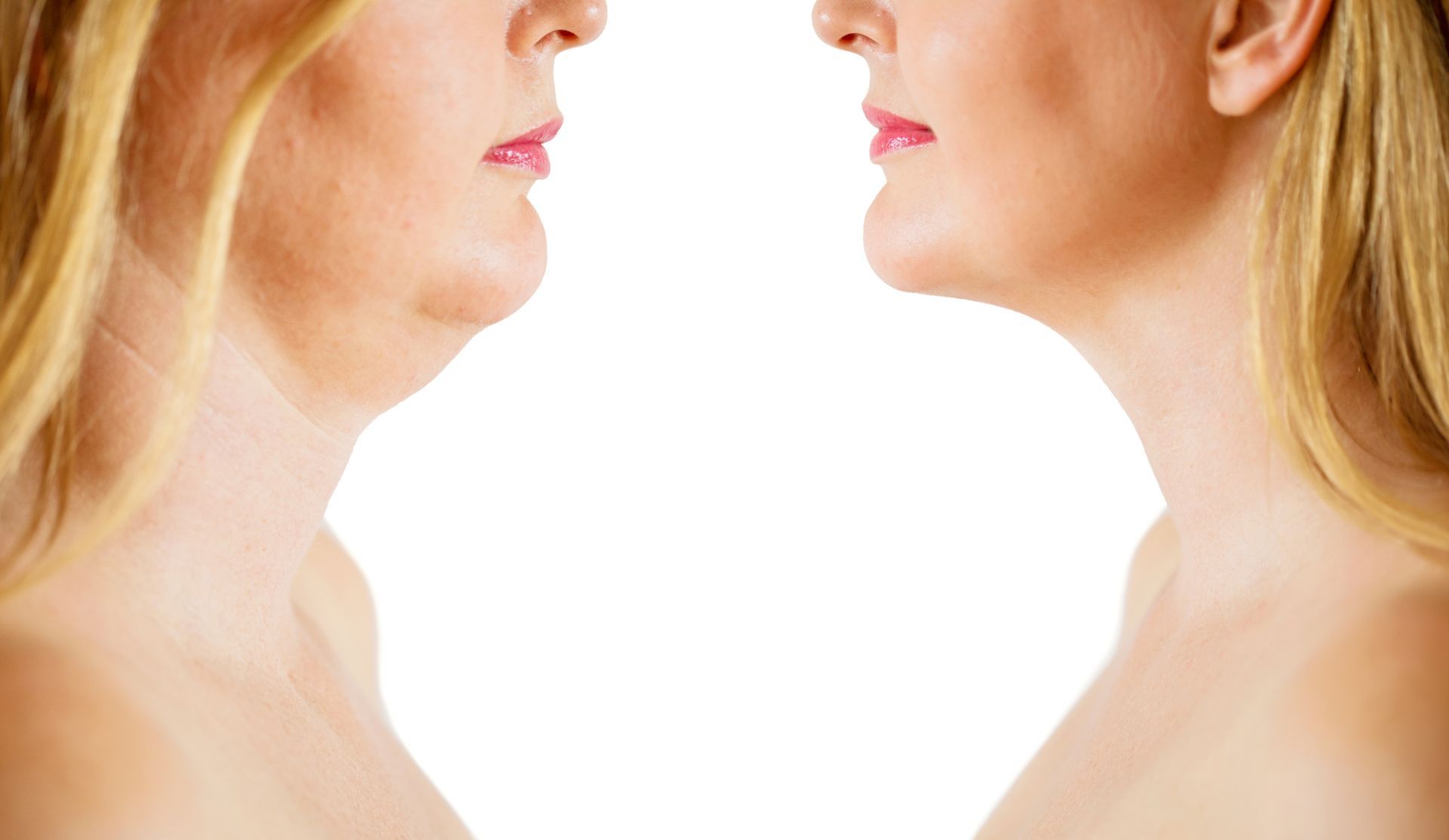 Side profile comparison showing a double chin before and a slimmer jawline after.