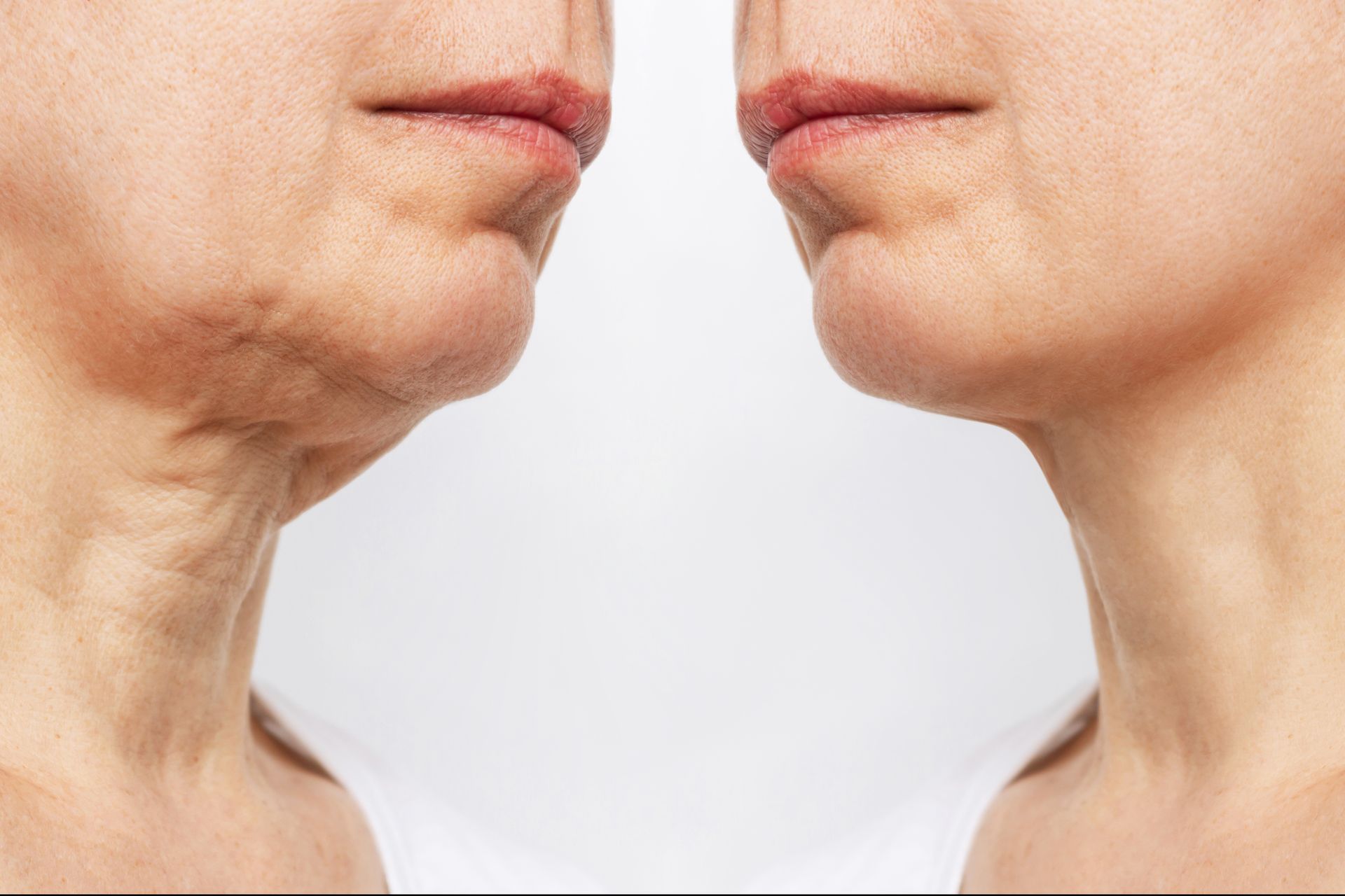 Side-by-side close-up profiles of two faces with sagging skin under the chin on a white background