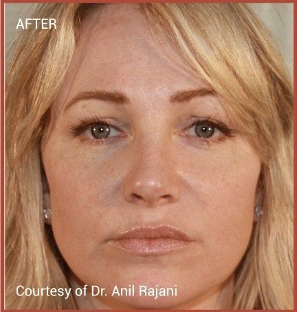 female patient before PRF treatment for brown spots
