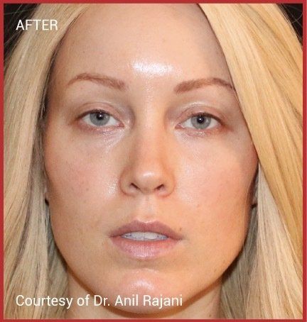 female patient after PRF treatment for dark circles