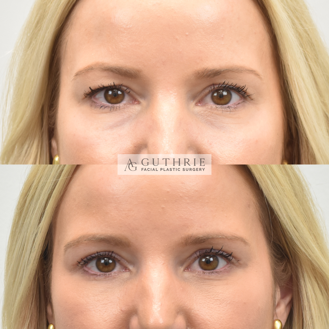 Before and After Upper and Lower Blepharoplasty