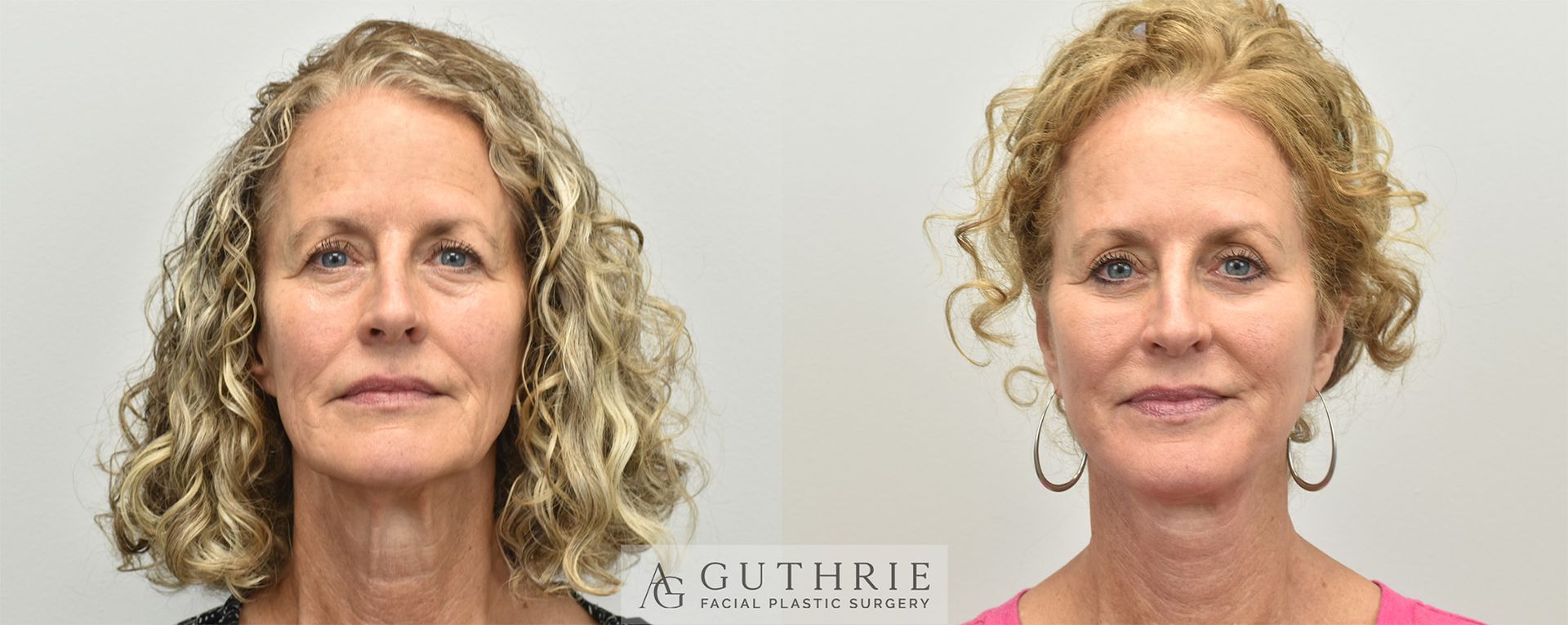 middle-age blonde woman before and after deep plane facelift performed by Dr. Ashley Guthrie