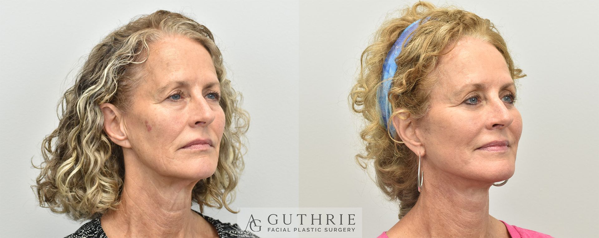 Before and After Deep Plane Facelift, Lower Blepharoplasty, Lateral Brow Lift, and CO2 Laser