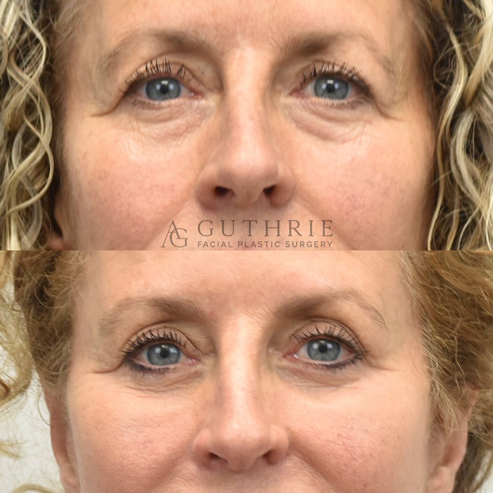 middle-age blonde woman before and after lower blepharoplasty performed by Dr. Ashley Guthrie