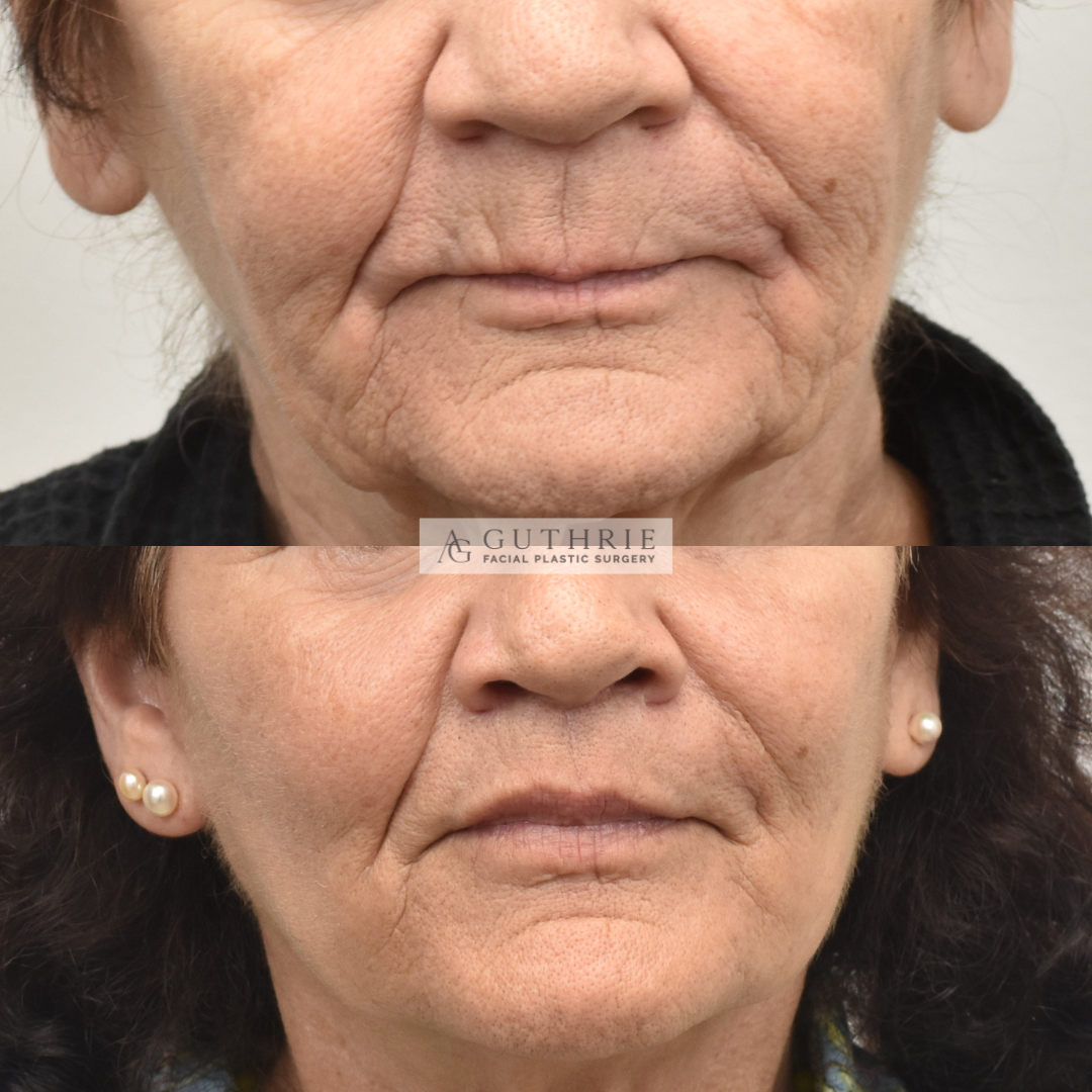 before and after subnasal lip lift at guthrie facial plastic surgery in brentwood tn