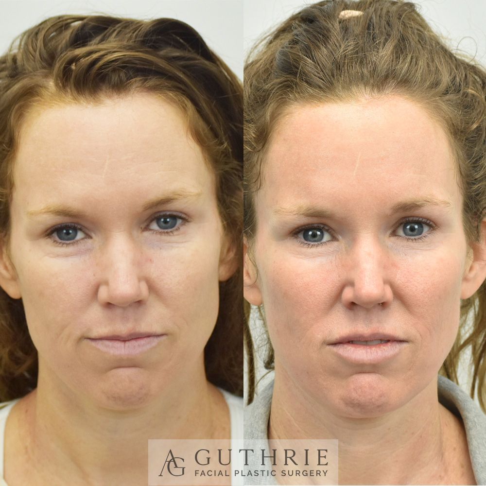 woman's face before and after FaceTite treatment