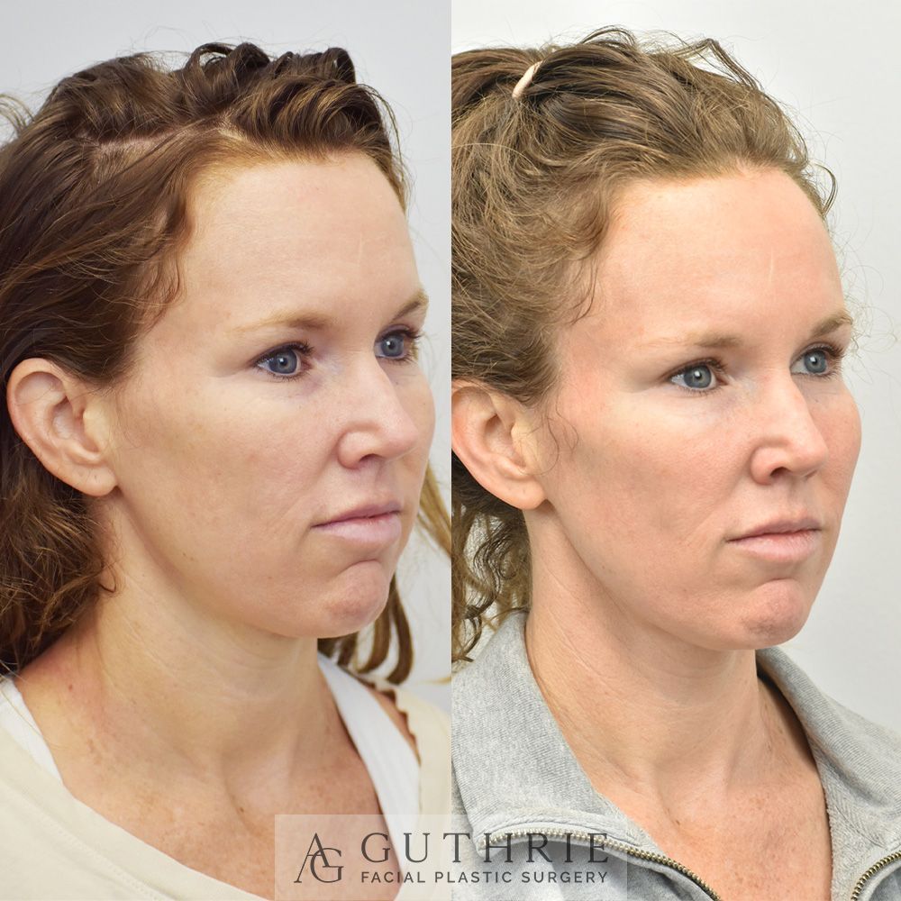 woman's face before and after morpheus8 treatment
