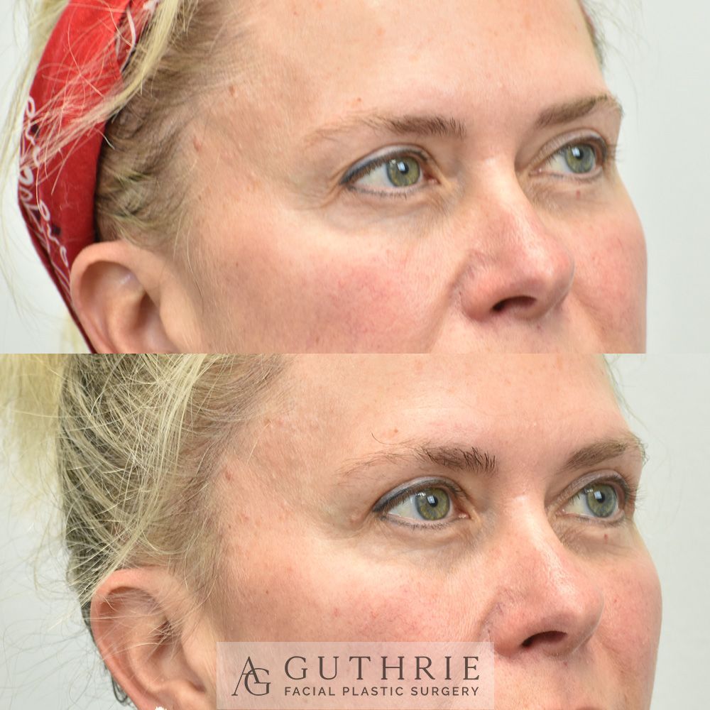 woman before and 1 month post-op upper blepharoplasty