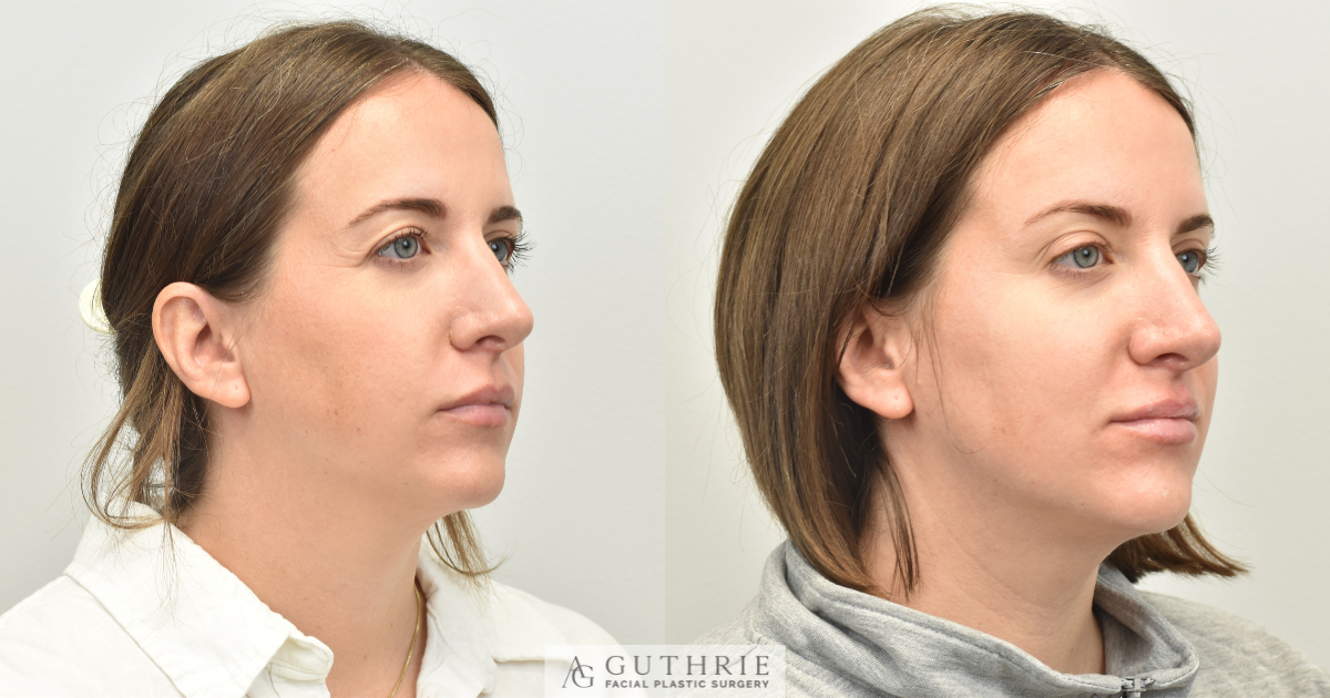 Before and After FaceTite Treatment