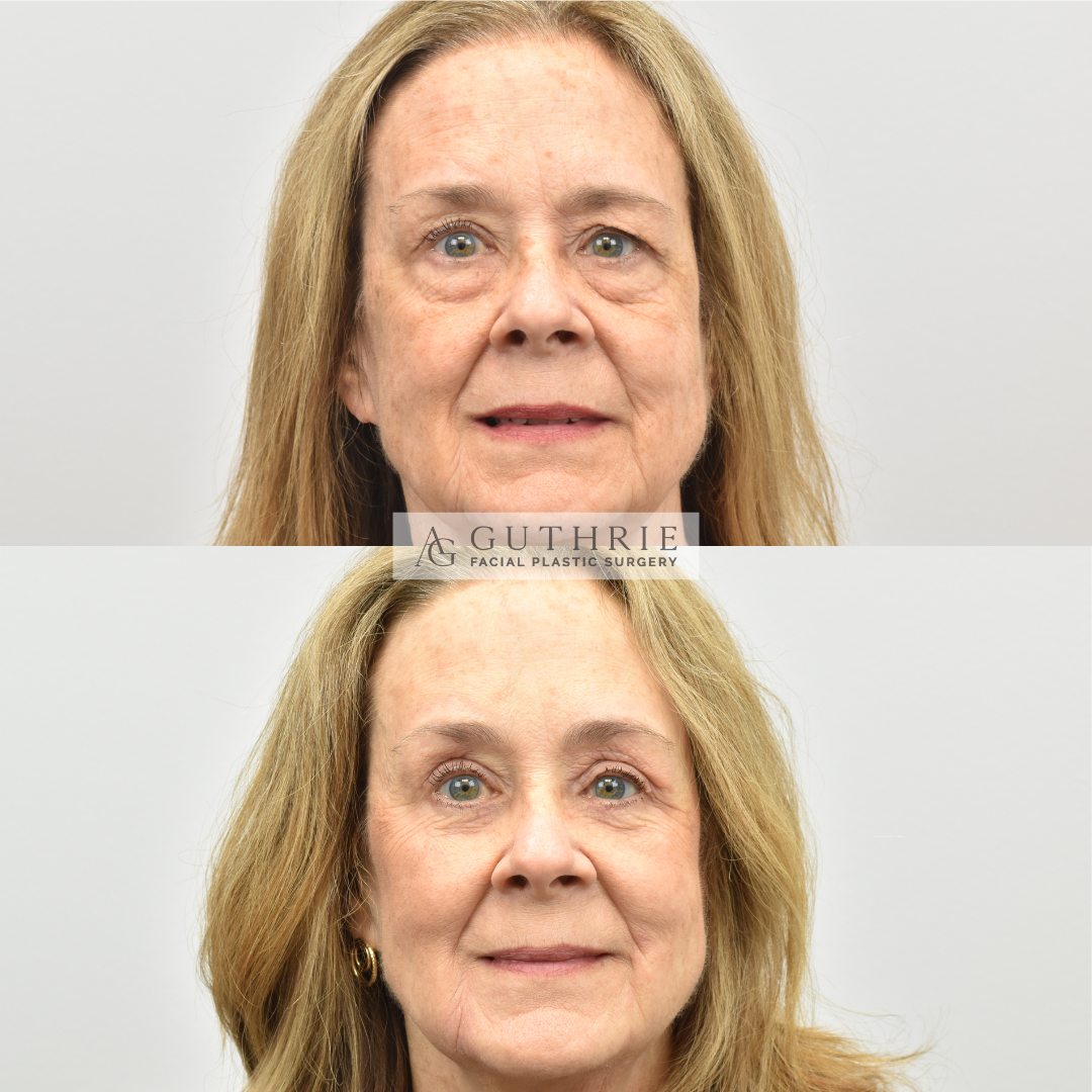 Before and After Brow Lift