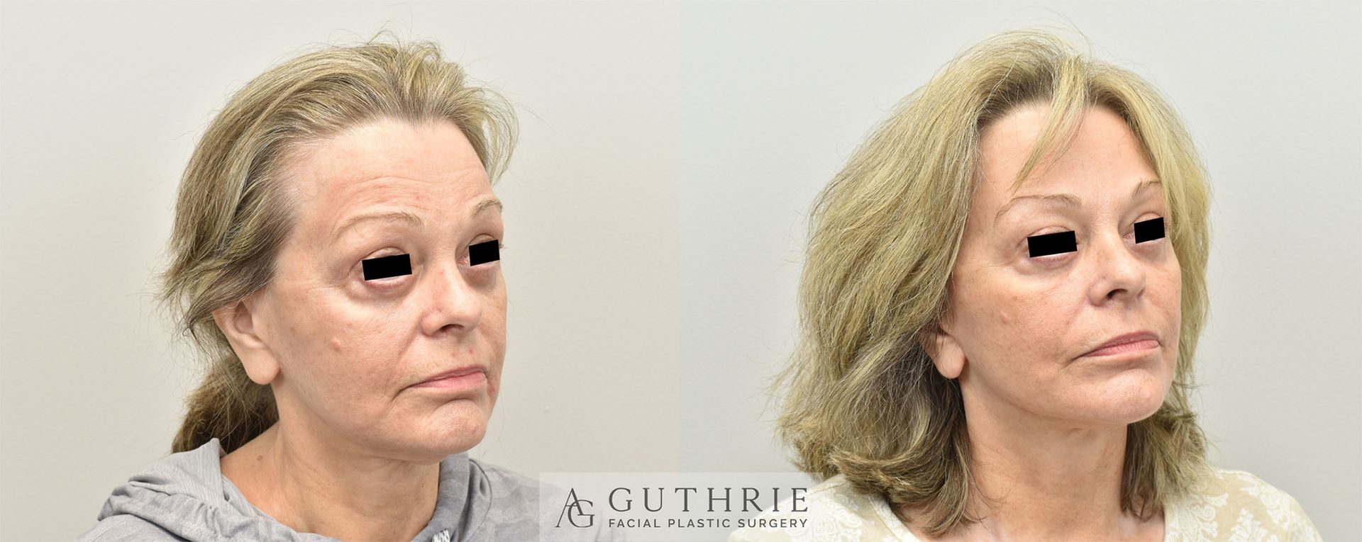 a woman's face before and after facelift and necklift performed by Dr. Ashely Guthrie