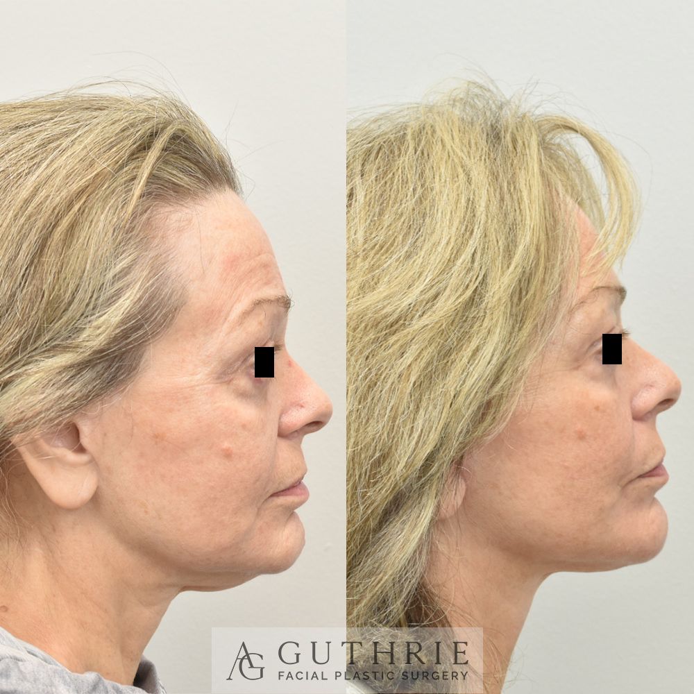 a woman's face before and after facelift and necklift performed by Dr. Ashely Guthrie