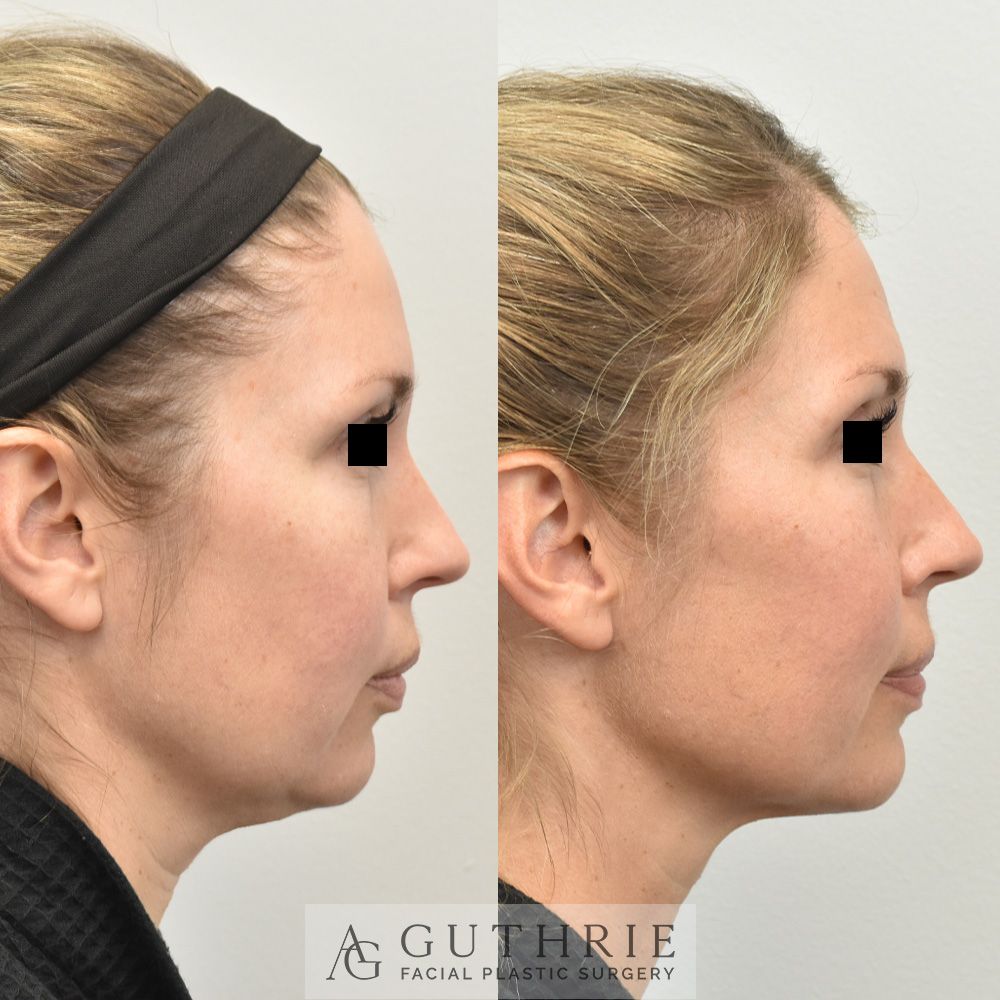 woman's face before and after FaceTite treatment