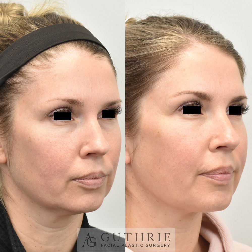 a woman before and after direct submental liposuction