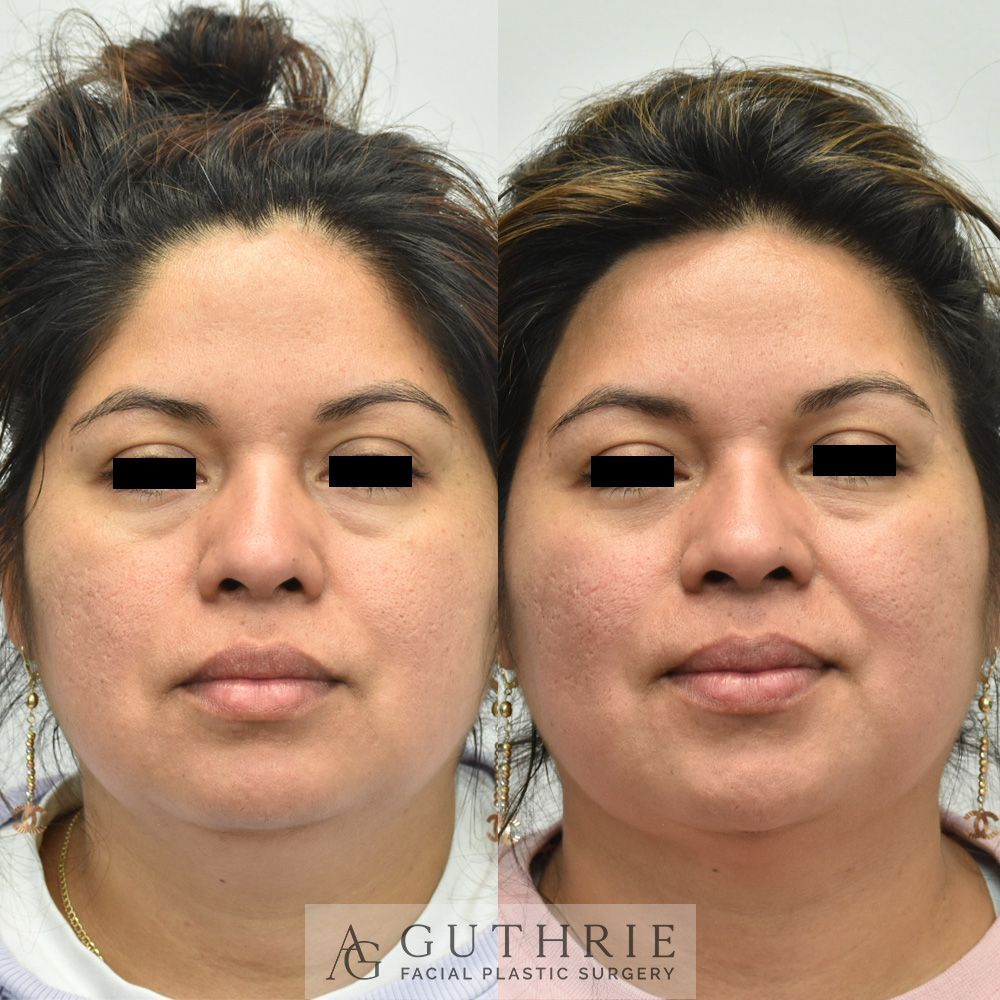 a woman's face before and after buccal fat reduction surgery at Guthrie Facial Plastic Surgery