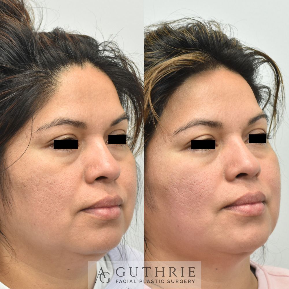 a woman before and after buccal fat reduction