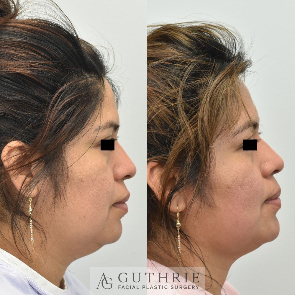 a woman's face before and after buccal fat reduction surgery at Guthrie Facial Plastic Surgery
