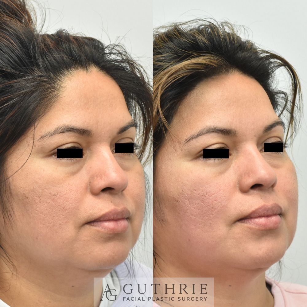Before and After Facetite Treatment, with Submental Liposuction and Buccal Fat Reduction