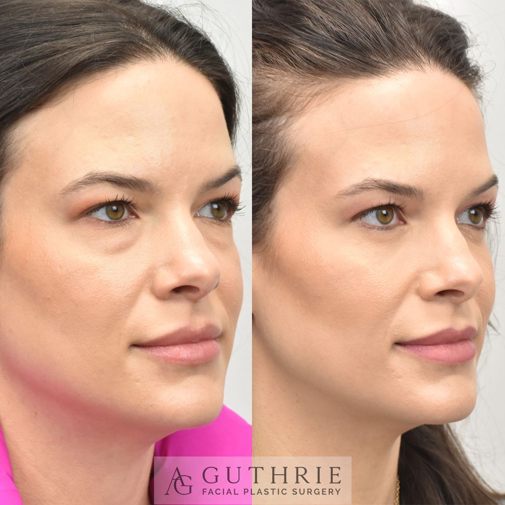 woman's face before and after lower blepharoplasty procedure