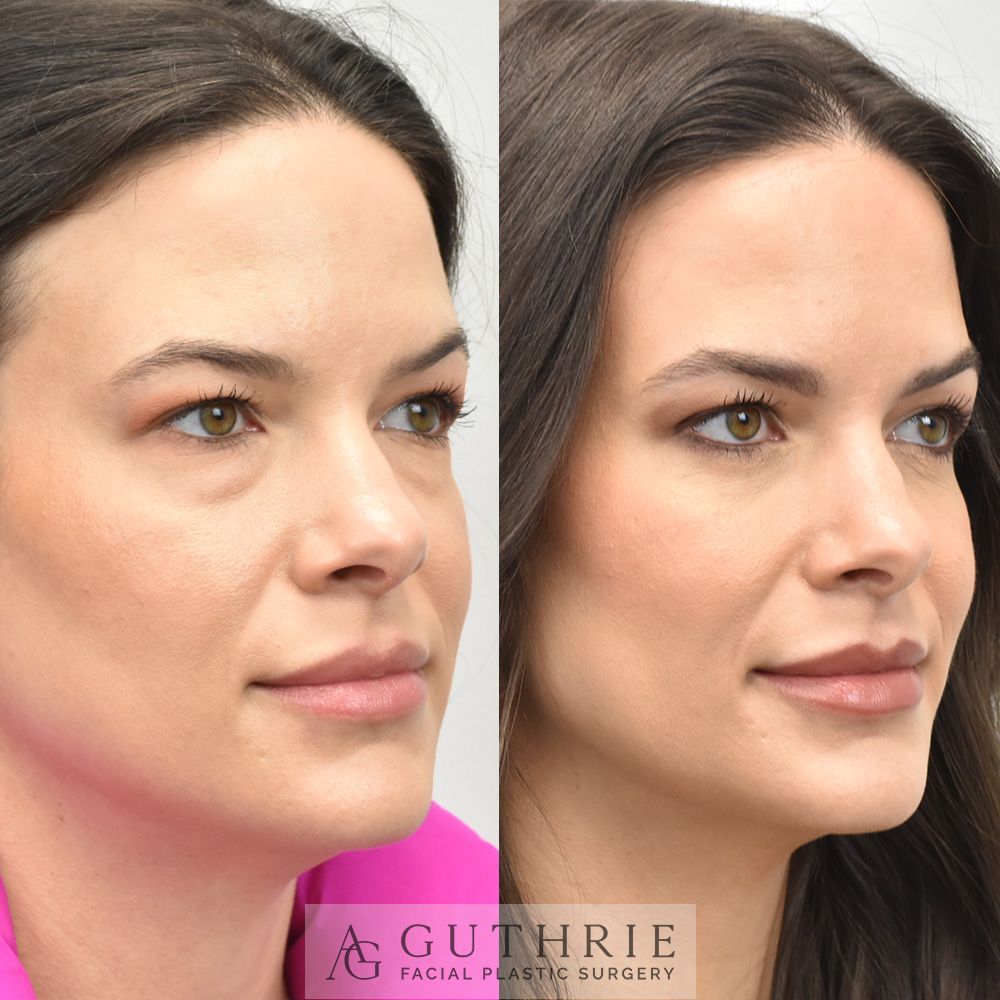 woman's face before and after lower blepharoplasty procedure