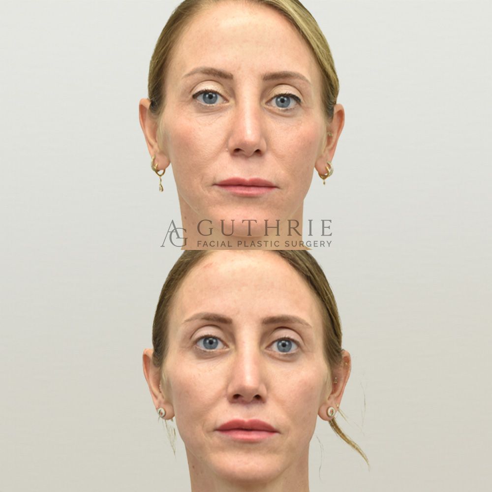 woman's face shown before and after subnasal lip lift procedure