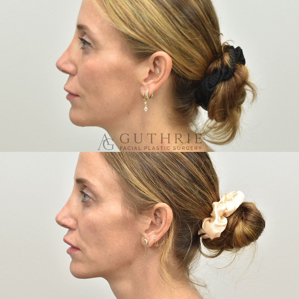 BEFORE AND AFTER SUBNASAL LIFT LIP IN NASHVILLE TN BY ASHLEY GUTHRIE