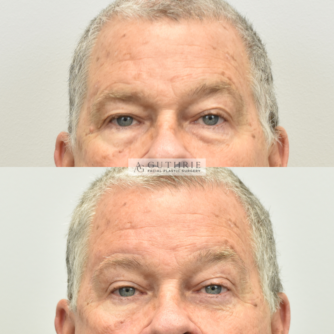 Before and After Upper and Lower Blepharoplasty, Direct Brow Lift - Guthrie Facial Plastic Surgery Brentwood TN