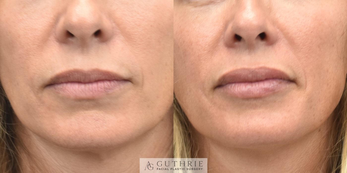 patient before and after lip fillers at guthrie facial plastic surgery in brentwood tn