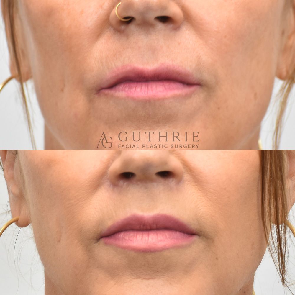 a woman's face shown before and after lip lift procedure by Dr. Ashley Guthrie