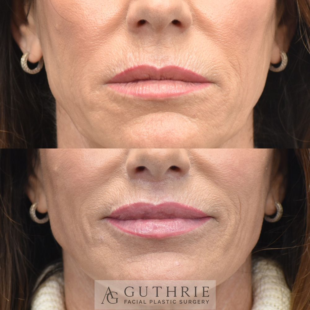 closeup of a woman's mouth before and after Subnasal Lip Lift
