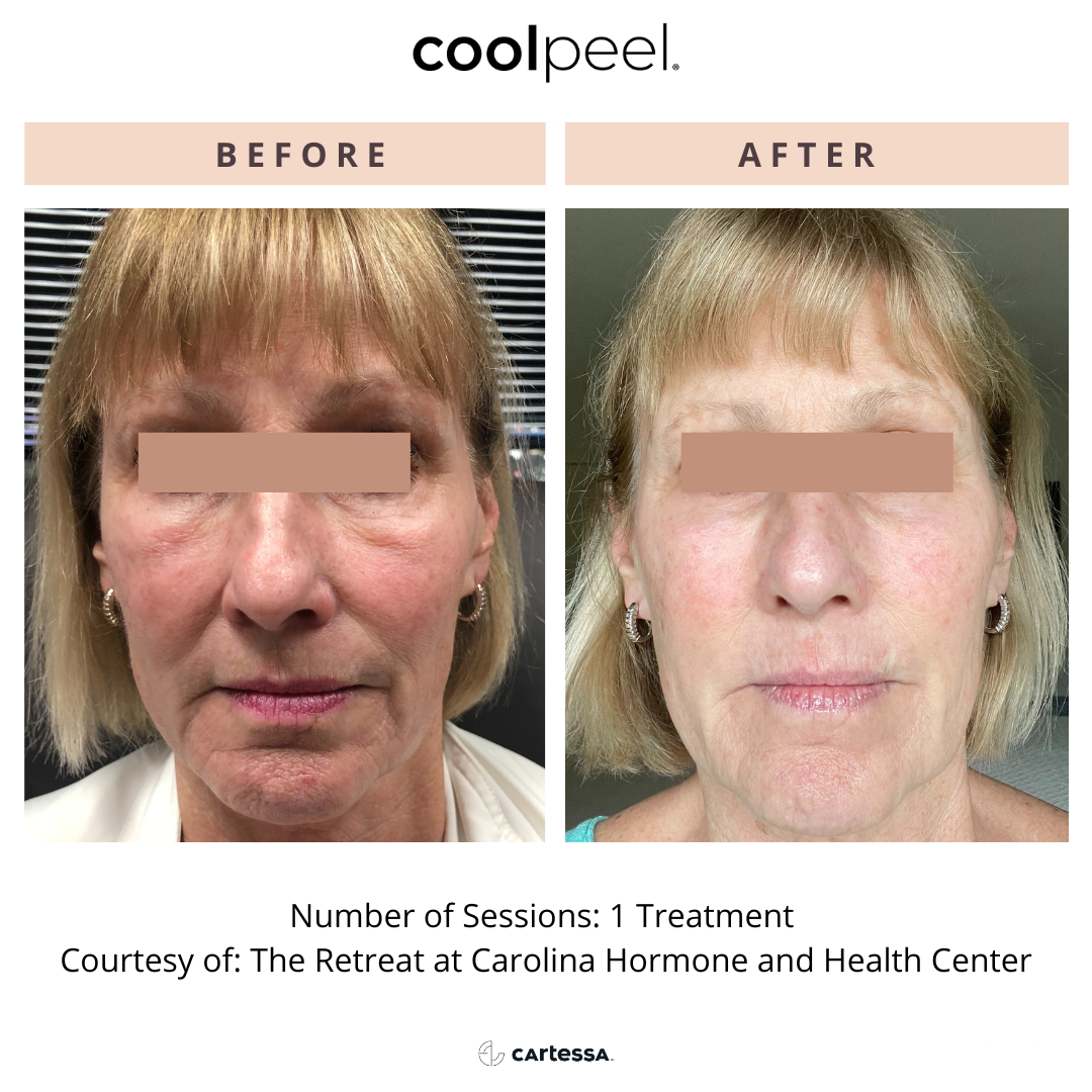 patient before and after CoolPeel laser treatment