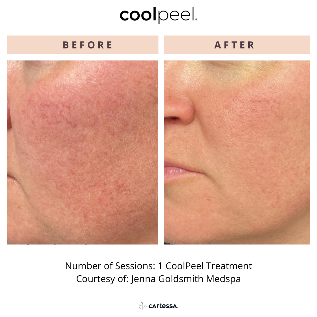 woman's face before and after CoolPeel treatment