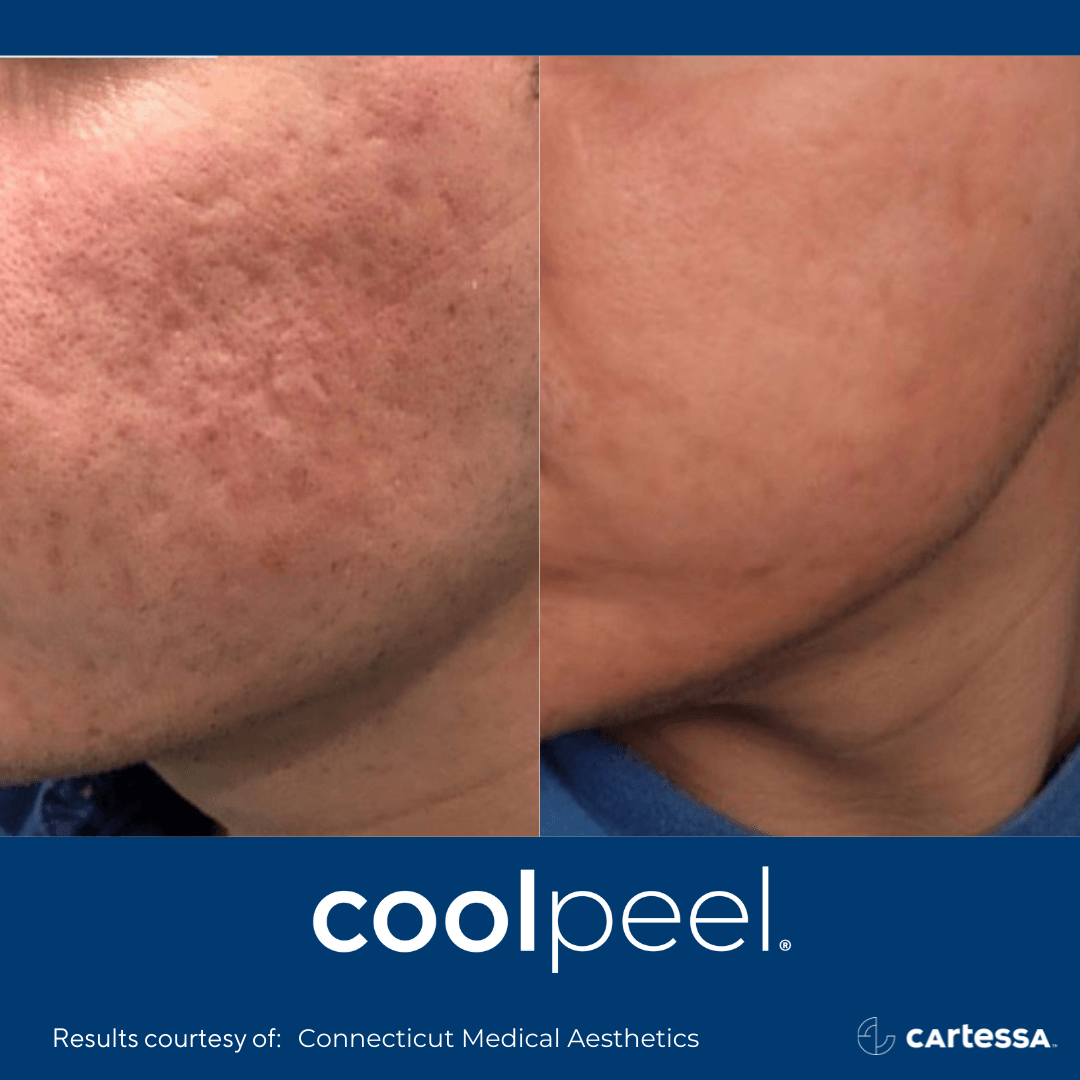 patient before and after coolpeel treatment on the cheek