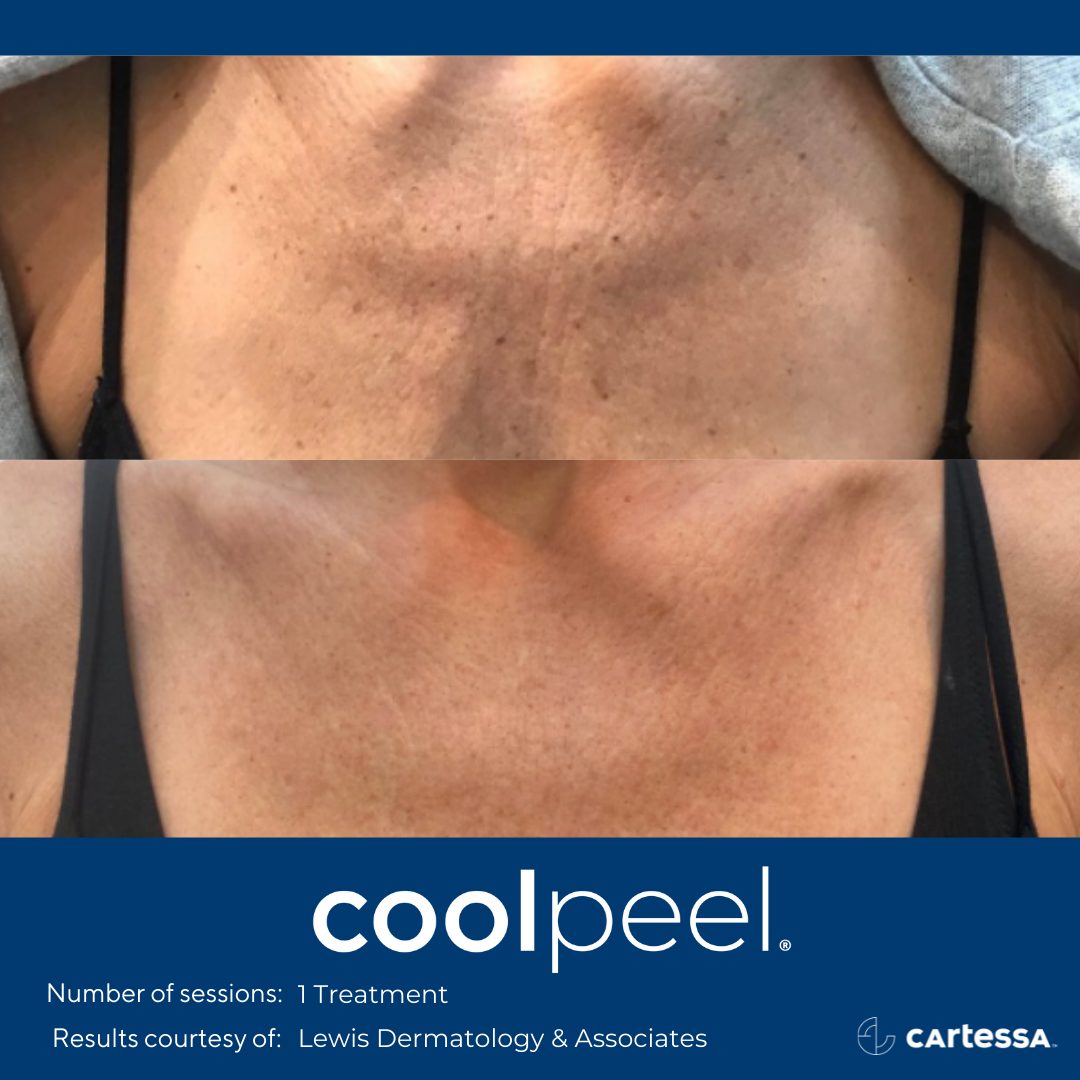 woman's decolette before and after CoolPeel treatment