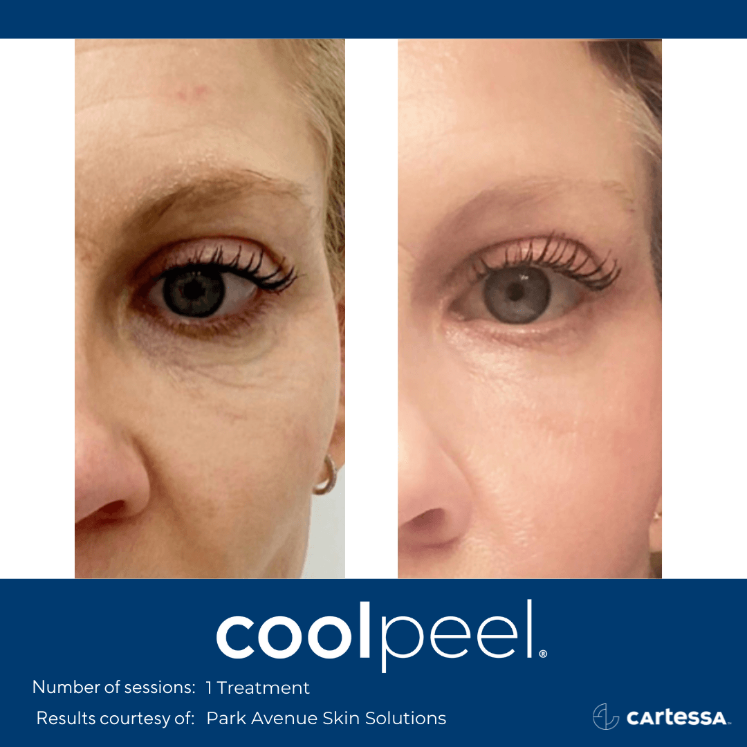 female patient before and after coolpeel treatment on the eyes