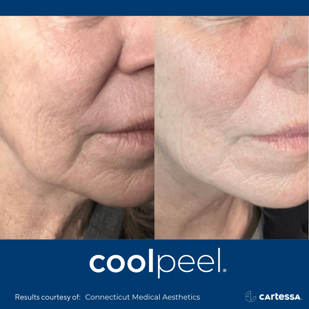 female patient before and after coolpeel treatment on the face