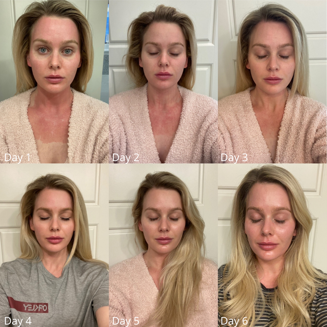 woman's face before and after CoolPeel treatment over the course of 6 days