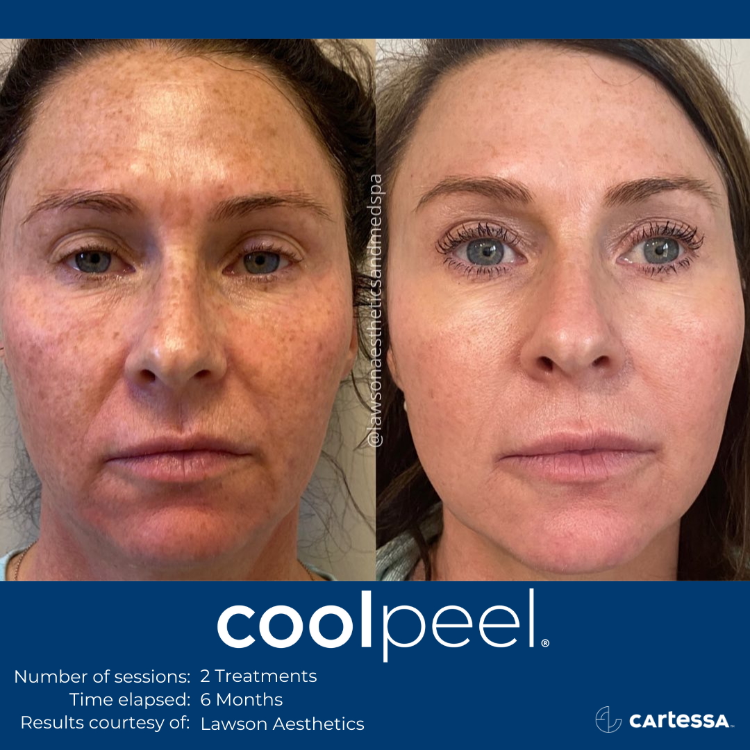 female patient before and after 2 coolpeel treatments on the face