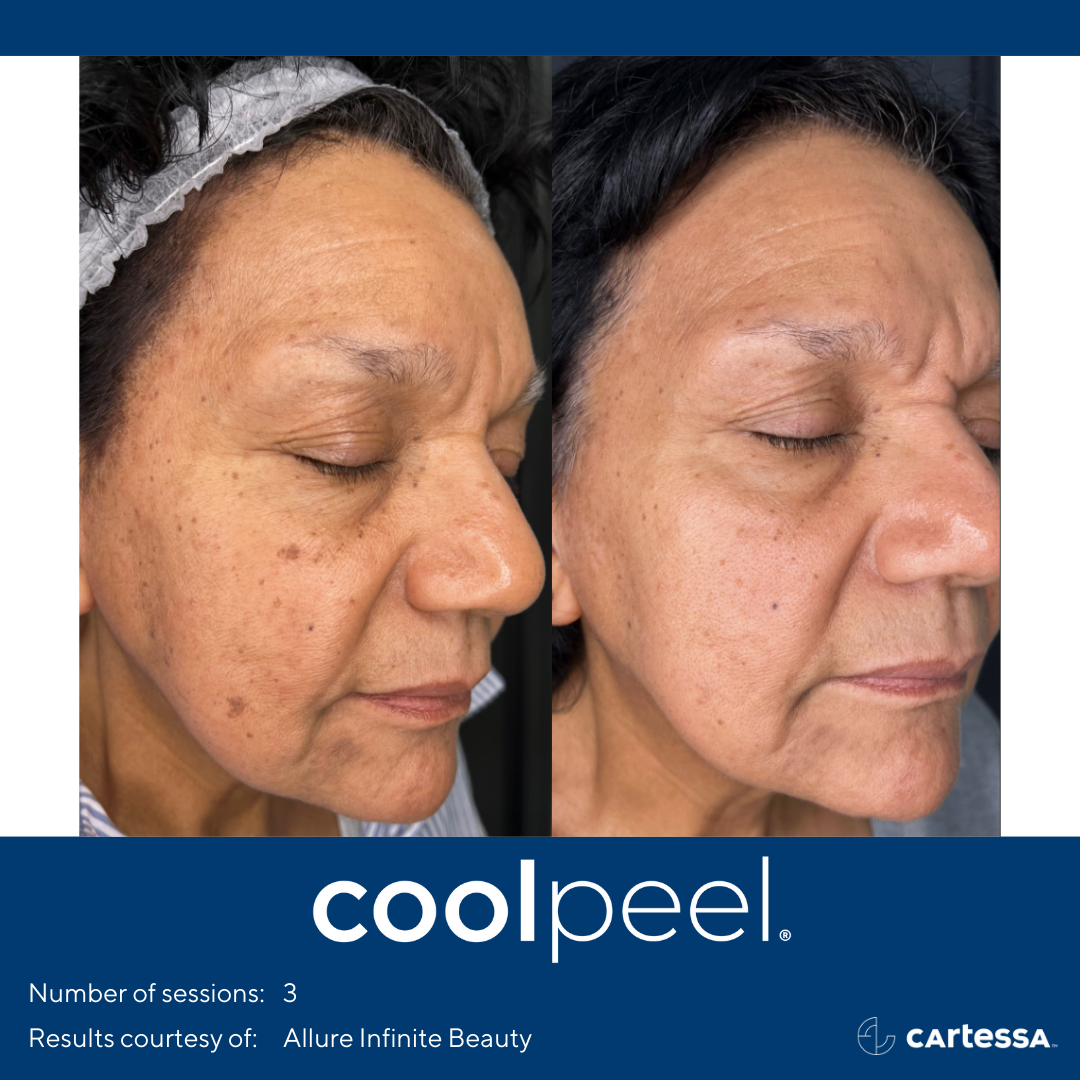 patient before and after CoolPeel laser treatment