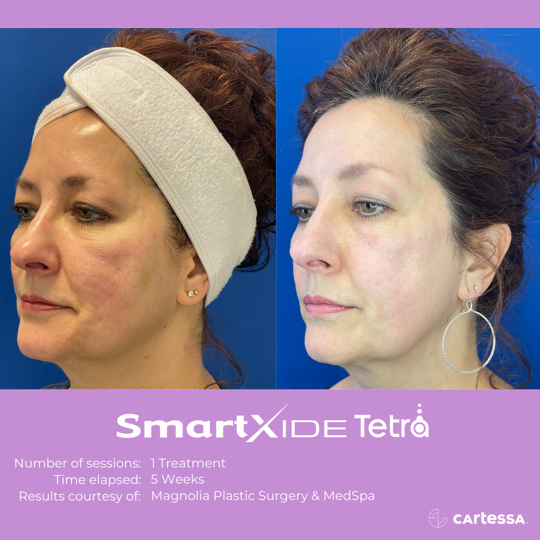 female patient before and after 1 tetra co2 laser treatment on the face