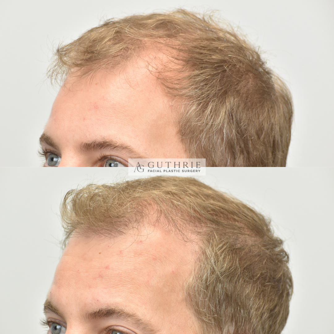 DB+Hair+Transplant+Before+and+After+in+Nashville+Guthrie+Facial+Plastic+Surgery+Brentwood