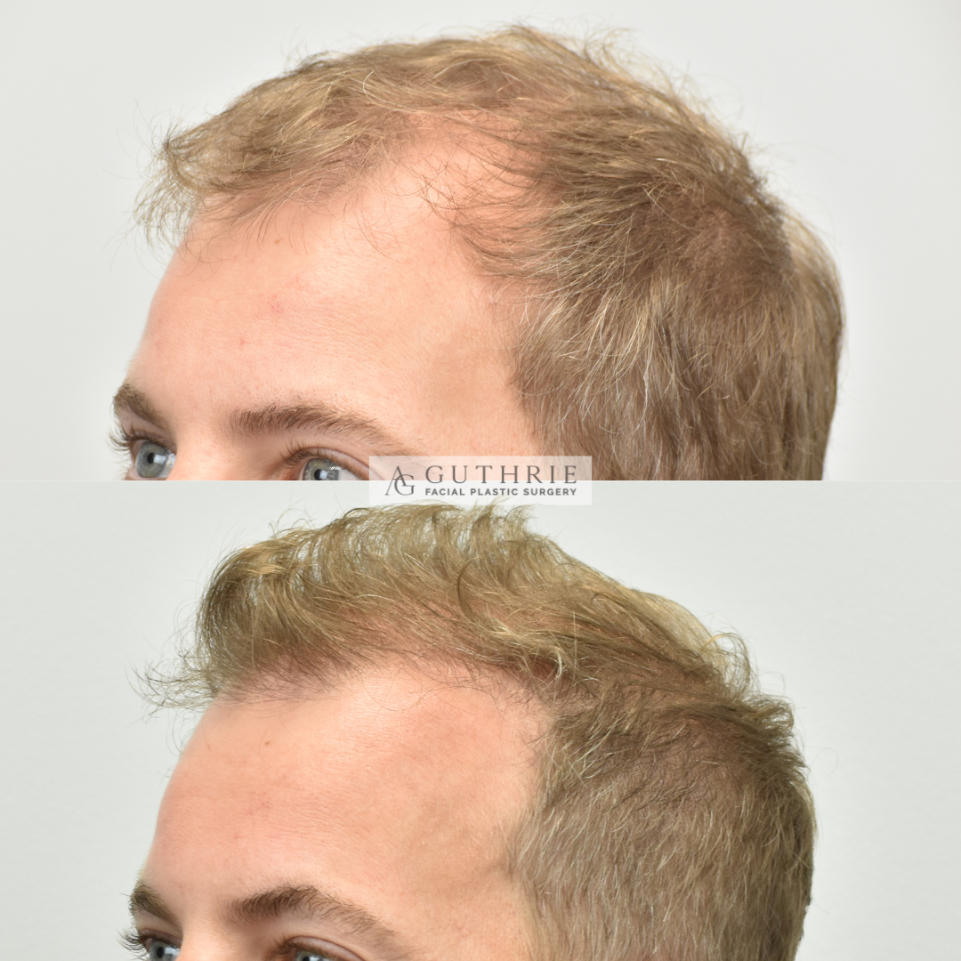 Patient at Dr. Guthrie's office before and after hair transplant procedure for hair growth in brentwood, tn