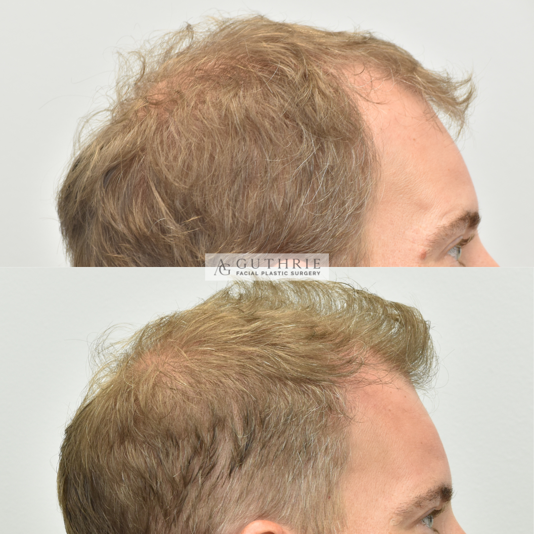 Patient at Dr. Guthrie's office before and after hair transplant procedure for hair growth in brentwood, tn