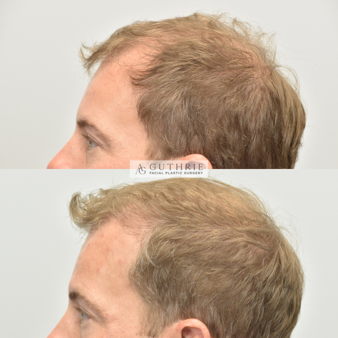 DB+Hair+Transplant+Before+and+After+in+Nashville+Guthrie+Facial+Plastic+Surgery+Brentwood