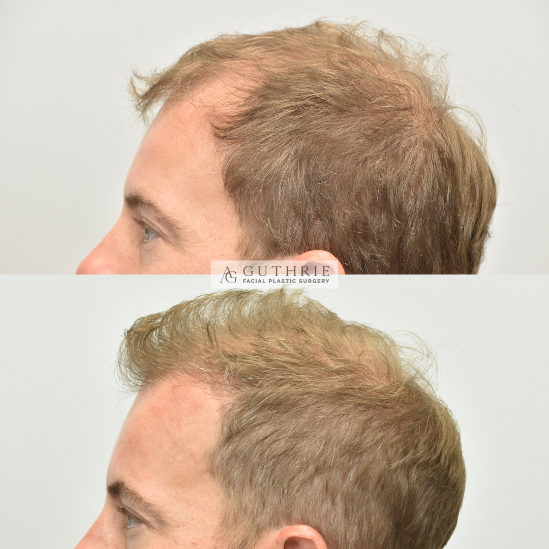 Patient at Dr. Guthrie's office before and after hair transplant procedure for hair growth in brentwood, tn