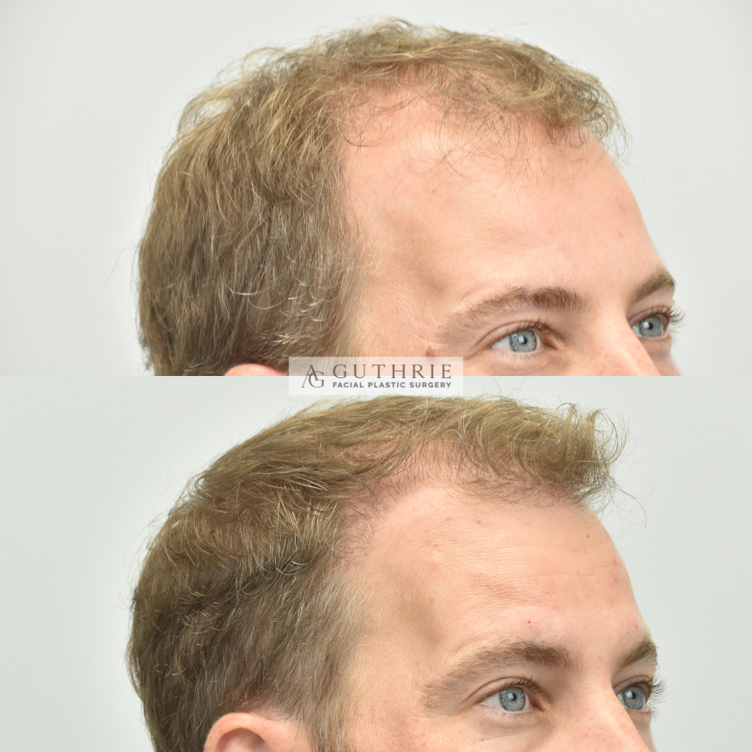 DB+Hair+Transplant+Before+and+After+in+Nashville+Guthrie+Facial+Plastic+Surgery+Brentwood