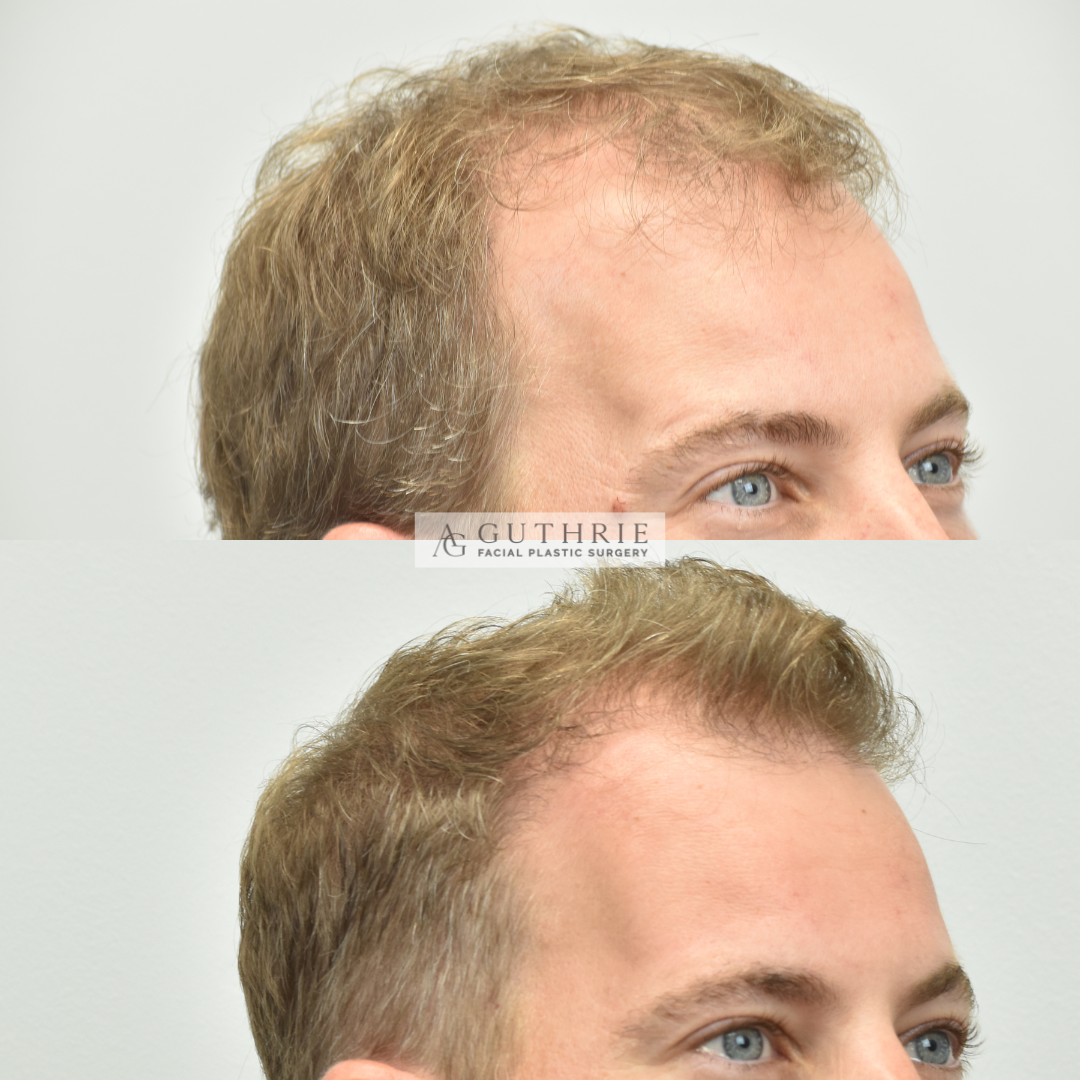 Patient at Dr. Guthrie's office before and after hair transplant procedure for hair growth in brentwood, tn